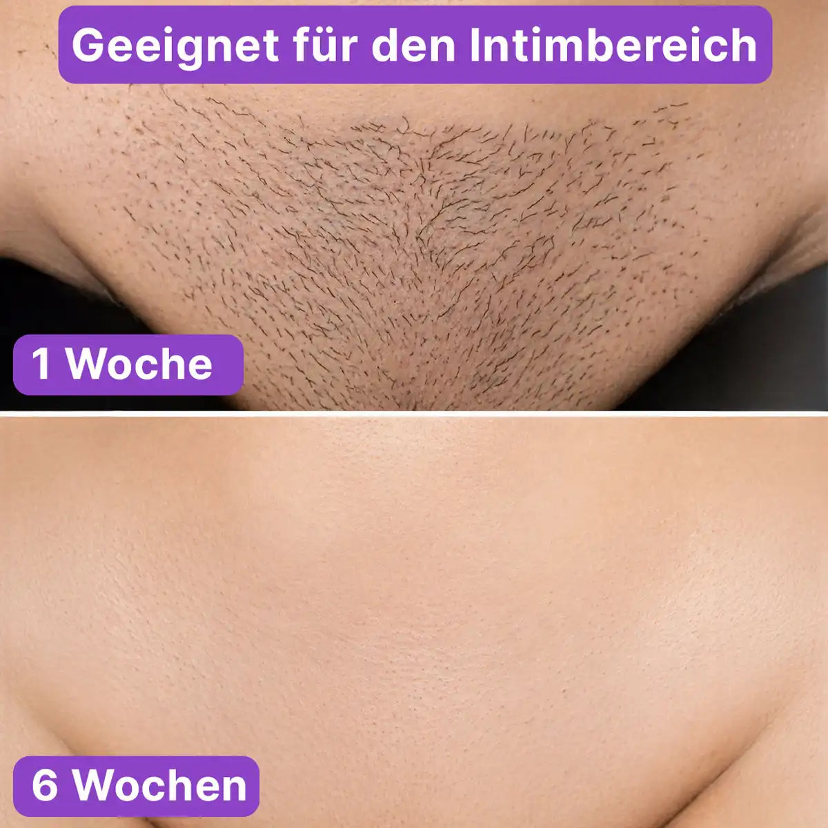 Vorher-Nachher Ergebnis von LULU Stop zur Haarwuchsreduzierung im Intimbereich nach 6 Wochen